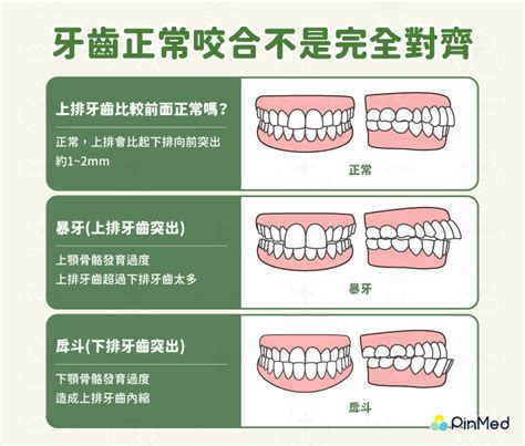 上排牙齒突出正常嗎